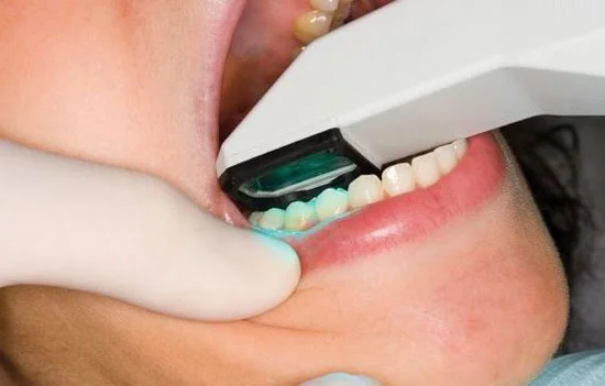  ESCANNER intraoral.