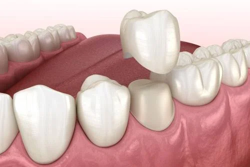 Alargamiento Coronario Estético 