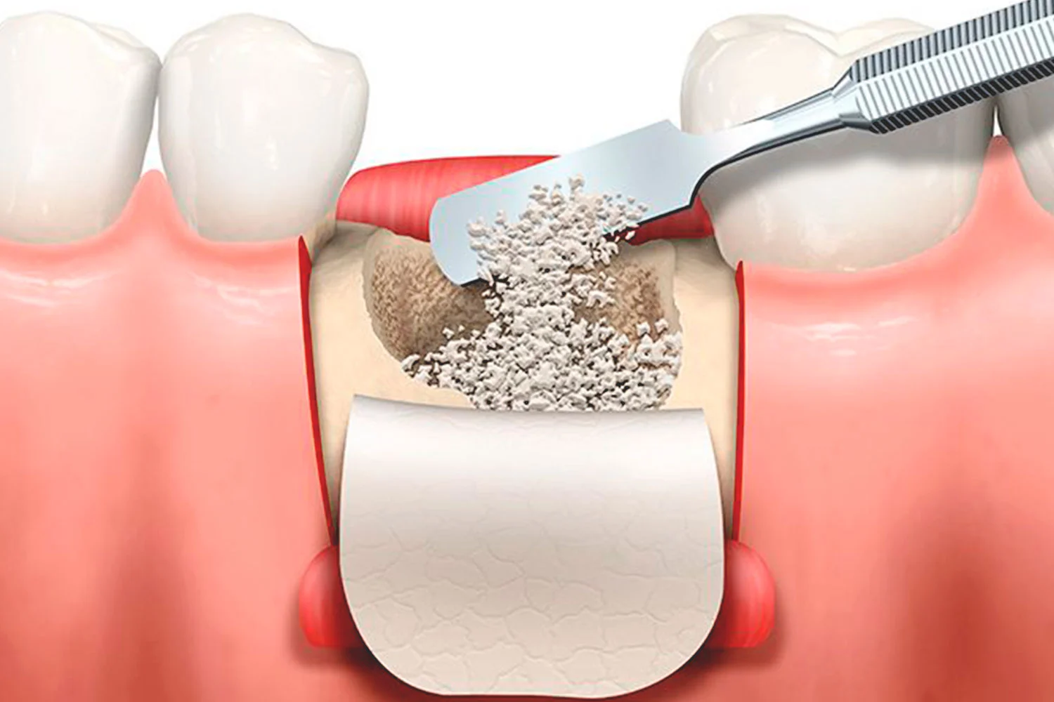 Extracción dental y Preservación Alveolar
