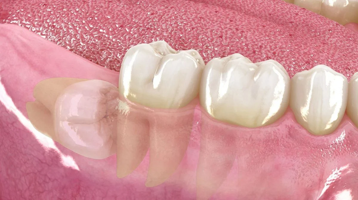 Extracción quirúrgica de terceros molares, cordales o del juicio