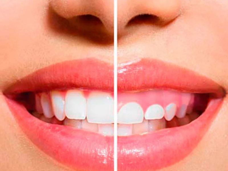 Gingivectomía / Gingivoplastía SIN BISTURÍ TÉCNICA AVANZADA