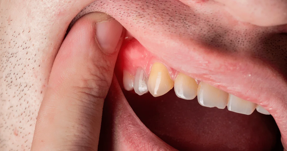 Tratamiento de Abscesos Gingivales / Periodontales