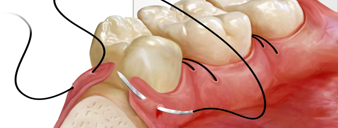 Eliminación de Quistes de origen Dental Intraoral