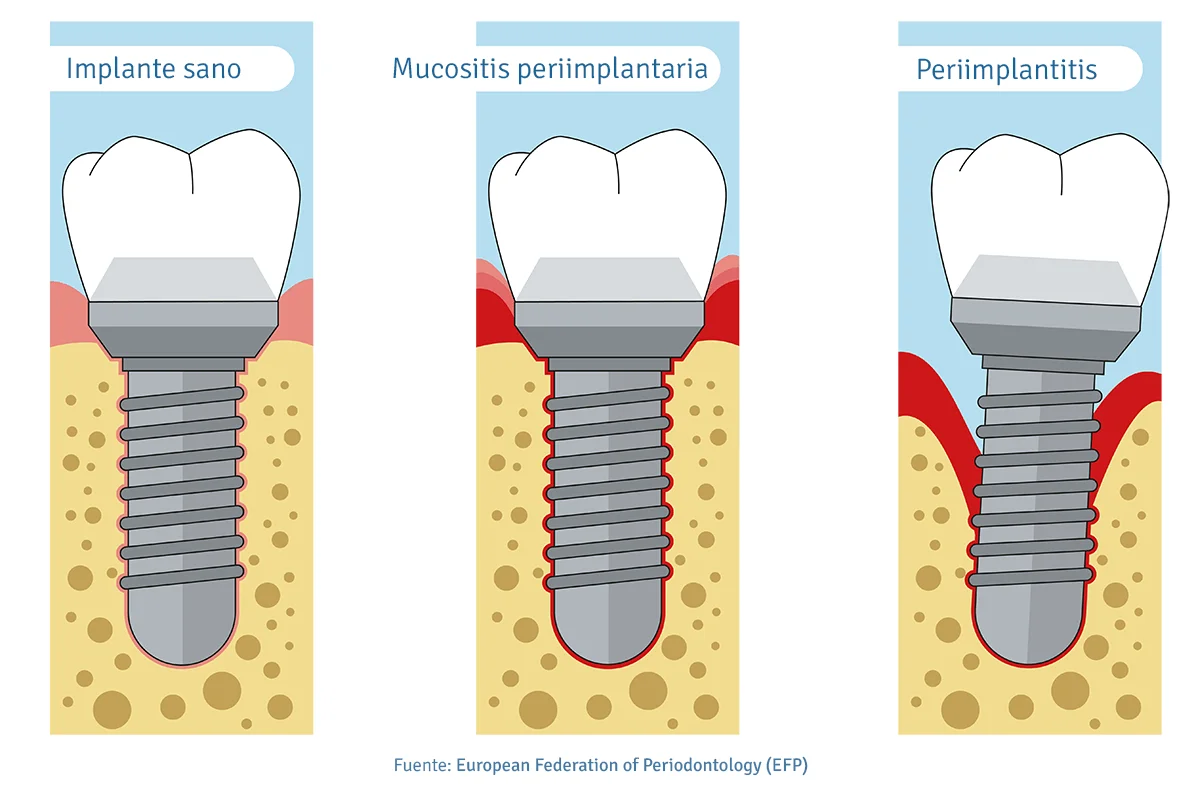 Tratamiento de la PERIIMPLANTITIS