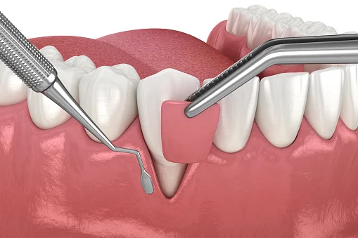 Injertos de Tejido Blando para mejorar calidad gingival