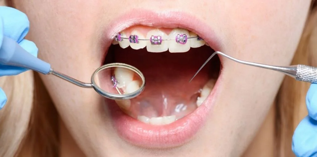 Valoración Periodontal PREVIO AL TRATAMIENTO DE ORTODONCIA