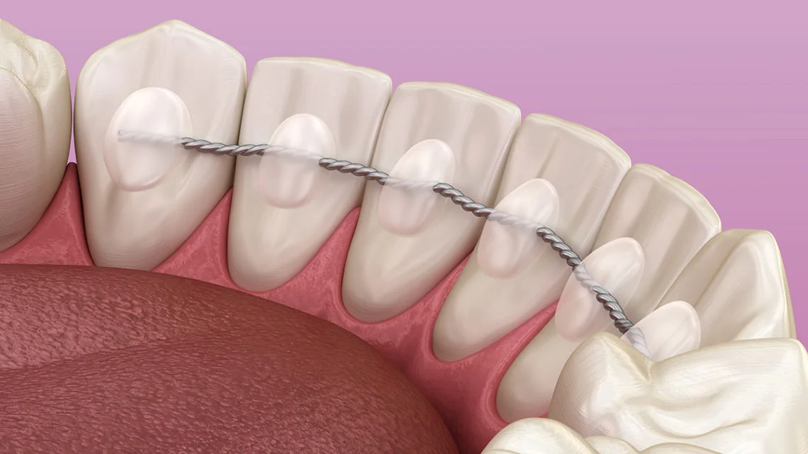 Tratamiento y Manejo de la Movilidad Dental de Moderada a Severa