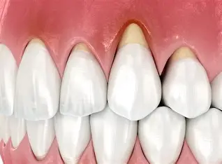 Tratamiento Preventivo de Recesiones Gingivales