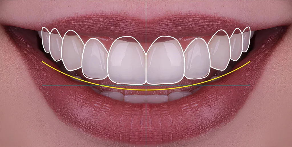 Diseño de Sonrisa sin Cirugía 