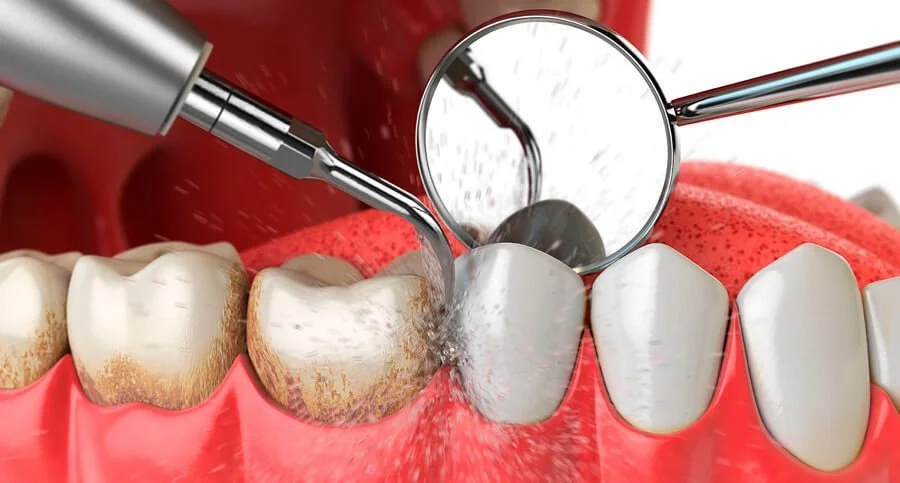 Mantenimiento periodontal BÁSICO 