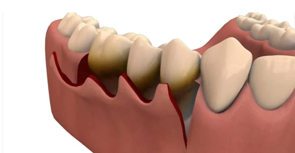 Tratamiento de Absceso Gingival / Periodontal PREMIUM