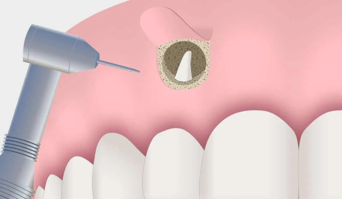 Cirugía Apical / Periapical