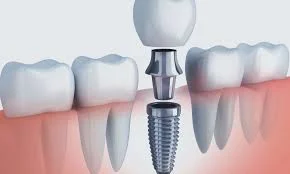 Mantenimiento de Implantes Dentales