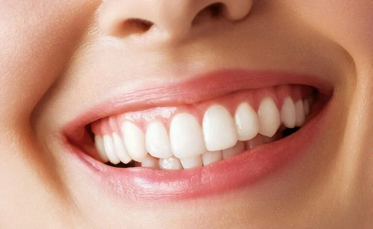 Tratamiento de Sonrisa Gingival LOCALIZADA